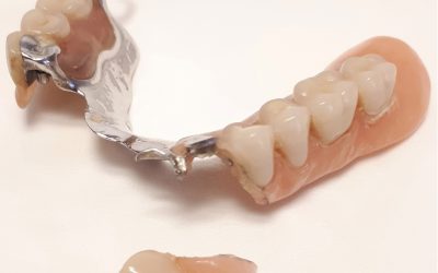 Riparazione Dentiere e Protesi Mobili in 1 ora.